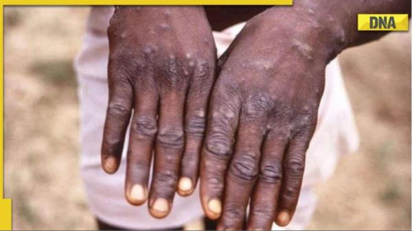 猴痘vs水痘:专家解释症状如何表现在这两种病毒性疾病