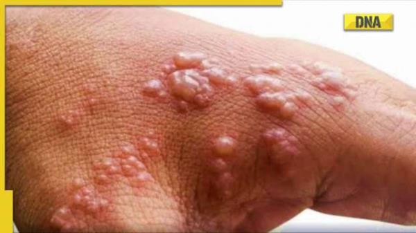 世卫组织说，猴痘:全球病例大幅下降，疫情趋于下降